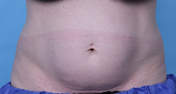 Before CoolSculpting® by Dr. Normand Miller, Salem, NH and Nashua, NH