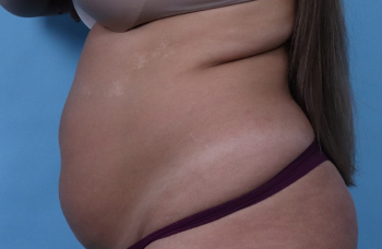 Before CoolSculpting® by Dr. Normand Miller, Salem, NH and Nashua, NH