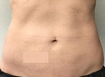 After Exilis Ultra™ Skin Tightening by Dr. Normand Miller, Salem, NH and Nashua, NH