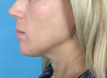 After Exilis Ultra™ Skin Tightening by Dr. Normand Miller, Salem, NH and Nashua, NH