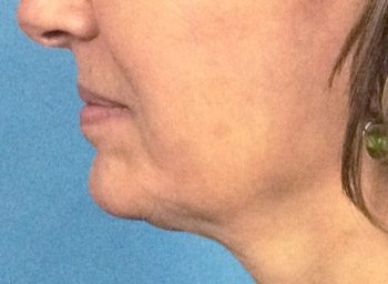 Before Exilis Ultra™ Skin Tightening by Dr. Normand Miller, Salem, NH and Nashua, NH