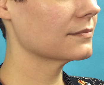 After Exilis Ultra™ Skin Tightening by Dr. Normand Miller, Salem, NH and Nashua, NH