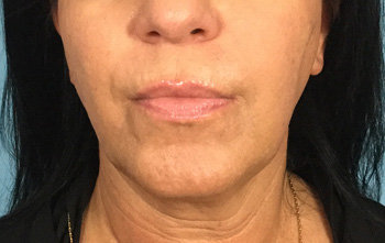 Before Exilis Ultra™ Skin Tightening by Dr. Normand Miller, Salem, NH and Nashua, NH