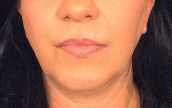 After Exilis Ultra™ Skin Tightening by Dr. Normand Miller, Salem, NH and Nashua, NH