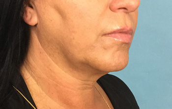 Before Exilis Ultra™ Skin Tightening by Dr. Normand Miller, Salem, NH and Nashua, NH