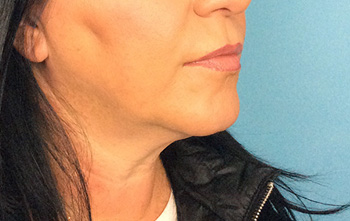 After Exilis Ultra™ Skin Tightening by Dr. Normand Miller, Salem, NH and Nashua, NH