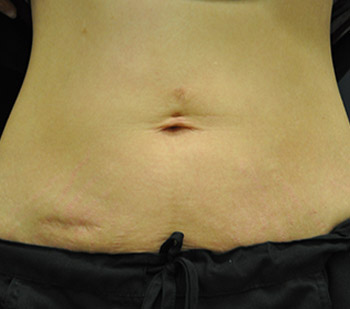 After Exilis Ultra™ Skin Tightening by Dr. Normand Miller, Salem, NH and Nashua, NH