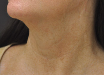 After Exilis Ultra™ Skin Tightening by Dr. Normand Miller, Salem, NH and Nashua, NH