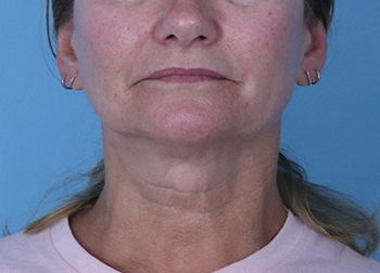After Exilis Ultra™ Skin Tightening by Dr. Normand Miller, Salem, NH and Nashua, NH