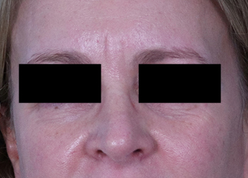 Before Exilis Ultra™ Skin Tightening by Dr. Normand Miller, Salem, NH and Nashua, NH