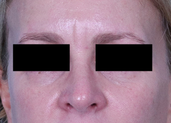 After Exilis Ultra™ Skin Tightening by Dr. Normand Miller, Salem, NH and Nashua, NH