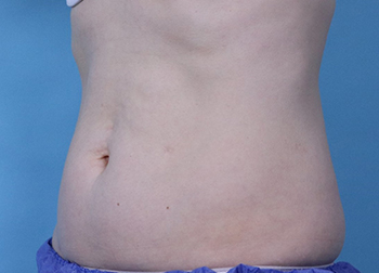 Before Exilis Ultra™ Skin Tightening by Dr. Normand Miller, Salem, NH and Nashua, NH