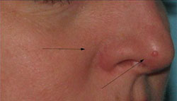 Before Facial Vein Treatment by Dr. Normand Miller, Salem, NH and Nashua, NH