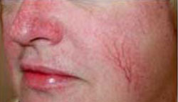 Before Facial Vein Treatment by Dr. Normand Miller, Salem, NH and Nashua, NH