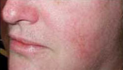 After Facial Vein Treatment by Dr. Normand Miller, Salem, NH and Nashua, NH