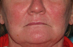 Before Facial Vein Treatment by Dr. Normand Miller, Salem, NH and Nashua, NH