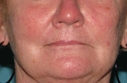 After Facial Vein Treatment by Dr. Normand Miller, Salem, NH and Nashua, NH