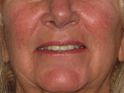 Before Facial Vein Treatment by Dr. Normand Miller, Salem, NH and Nashua, NH