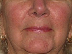 After Facial Vein Treatment by Dr. Normand Miller, Salem, NH and Nashua, NH