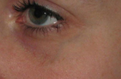 Before Facial Vein Treatment by Dr. Normand Miller, Salem, NH and Nashua, NH