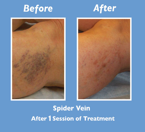 Before and After Spider Vein Treatment by Dr. Normand Miller, Salem, NH and Nashua, NH