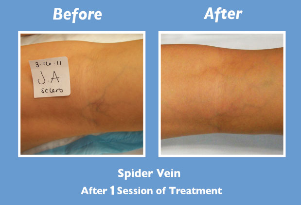 Before and After Spider Vein Treatment by Dr. Normand Miller, Salem, NH and Nashua, NH