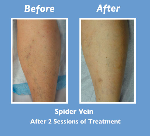 Before and After Spider Vein Treatment by Dr. Normand Miller, Salem, NH and Nashua, NH