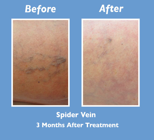 Before and After Spider Vein Treatment by Dr. Normand Miller, Salem, NH and Nashua, NH