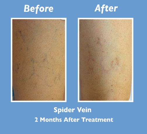 Before and After Spider Vein Treatment by Dr. Normand Miller, Salem, NH and Nashua, NH