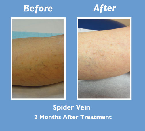 Before and After Spider Vein Treatment by Dr. Normand Miller, Salem, NH and Nashua, NH