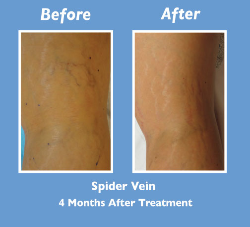 Before and After Spider Vein Treatment by Dr. Normand Miller, Salem, NH and Nashua, NH