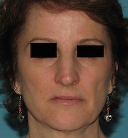 Before Facial Filler by Dr. Normand Miller, Salem, NH and Nashua, NH