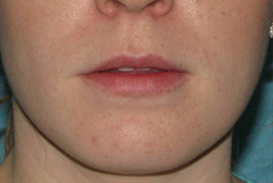 Before Facial Filler by Dr. Normand Miller, Salem, NH and Nashua, NH