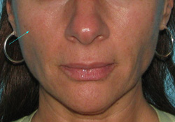 Before Facial Filler by Dr. Normand Miller, Salem, NH and Nashua, NH