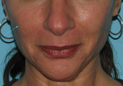 After Facial Filler by Dr. Normand Miller, Salem, NH and Nashua, NH