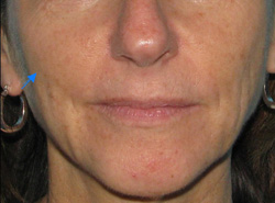 Before Facial Filler by Dr. Normand Miller, Salem, NH and Nashua, NH