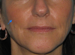 After Facial Filler by Dr. Normand Miller, Salem, NH and Nashua, NH