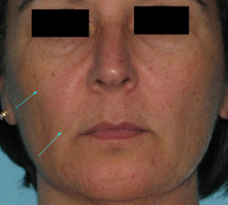 Before Facial Filler by Dr. Normand Miller, Salem, NH and Nashua, NH