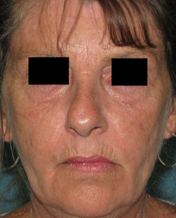 Before Facial Filler by Dr. Normand Miller, Salem, NH and Nashua, NH