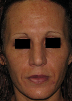 Before Facial Filler by Dr. Normand Miller, Salem, NH and Nashua, NH