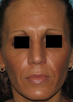 After Facial Filler by Dr. Normand Miller, Salem, NH and Nashua, NH