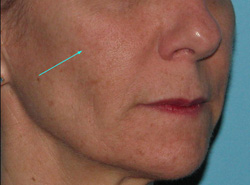 Before Facial Filler by Dr. Normand Miller, Salem, NH and Nashua, NH