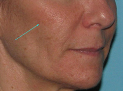 After Facial Filler by Dr. Normand Miller, Salem, NH and Nashua, NH