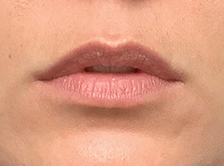 Before Facial Filler by Dr. Normand Miller, Salem, NH and Nashua, NH