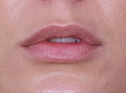 After Facial Filler by Dr. Normand Miller, Salem, NH and Nashua, NH