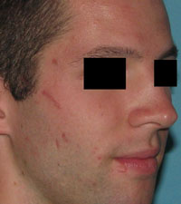 Before Laser / IPL by Dr. Normand Miller, Salem, NH and Nashua, NH