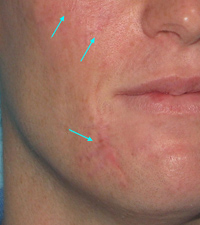 Before Laser / IPL by Dr. Normand Miller, Salem, NH and Nashua, NH