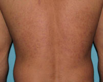 Before Laser / IPL by Dr. Normand Miller, Salem, NH and Nashua, NH
