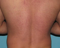 After Laser / IPL by Dr. Normand Miller, Salem, NH and Nashua, NH