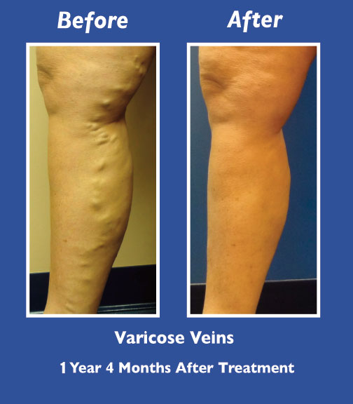 Before and After Leg Vein Treatment by Dr. Normand Miller, Salem, NH and Nashua, NH